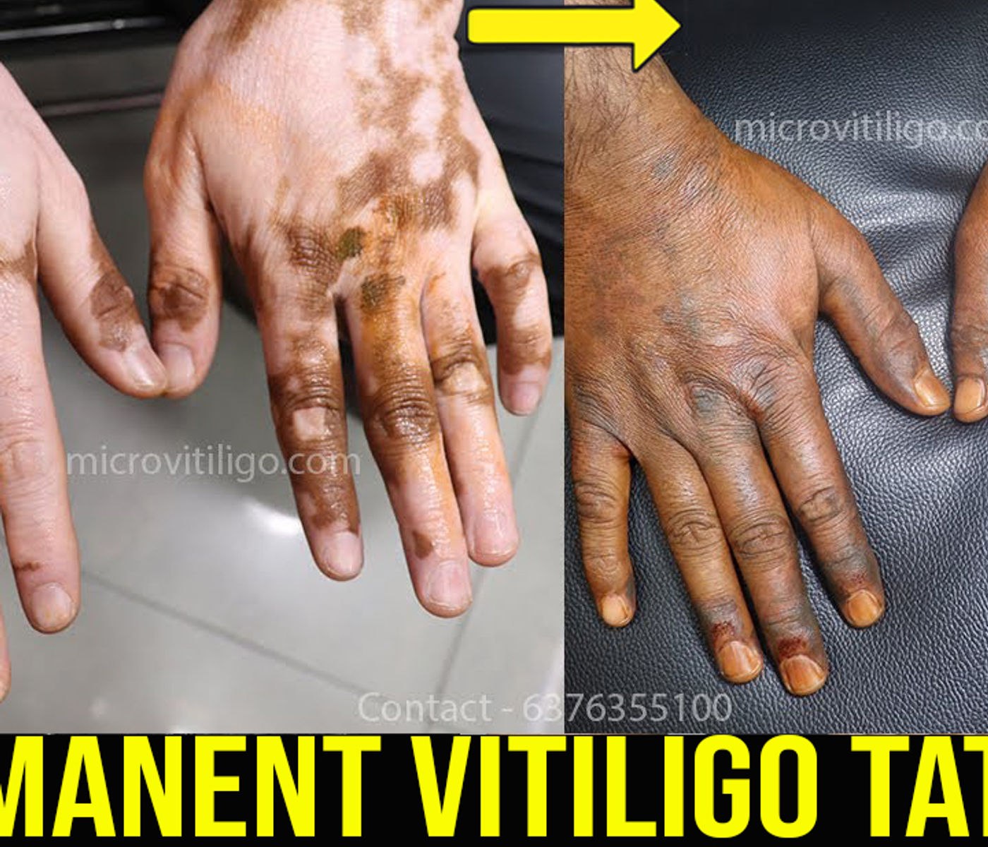Cosmetic skin camouflage result