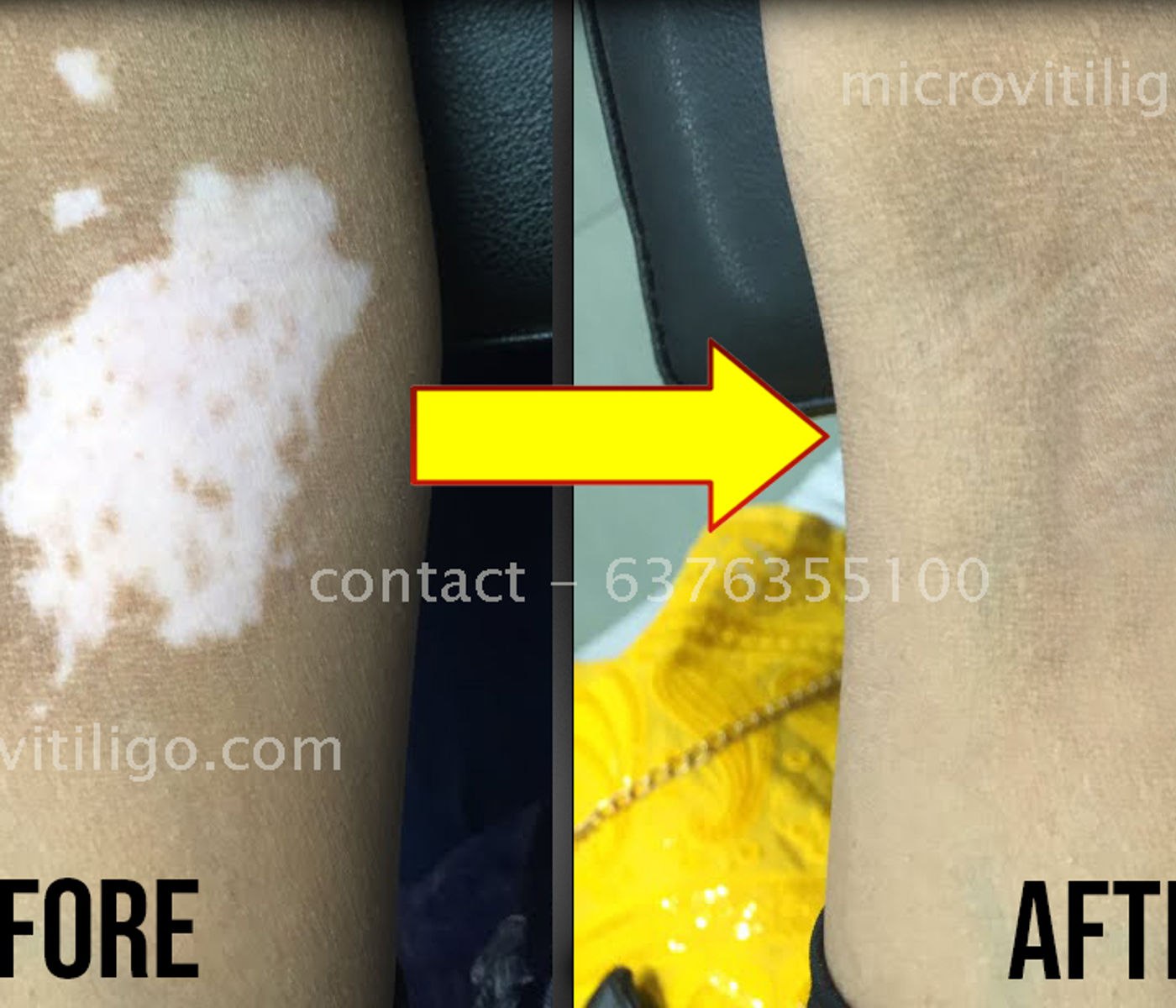 Cosmetic skin camouflage result