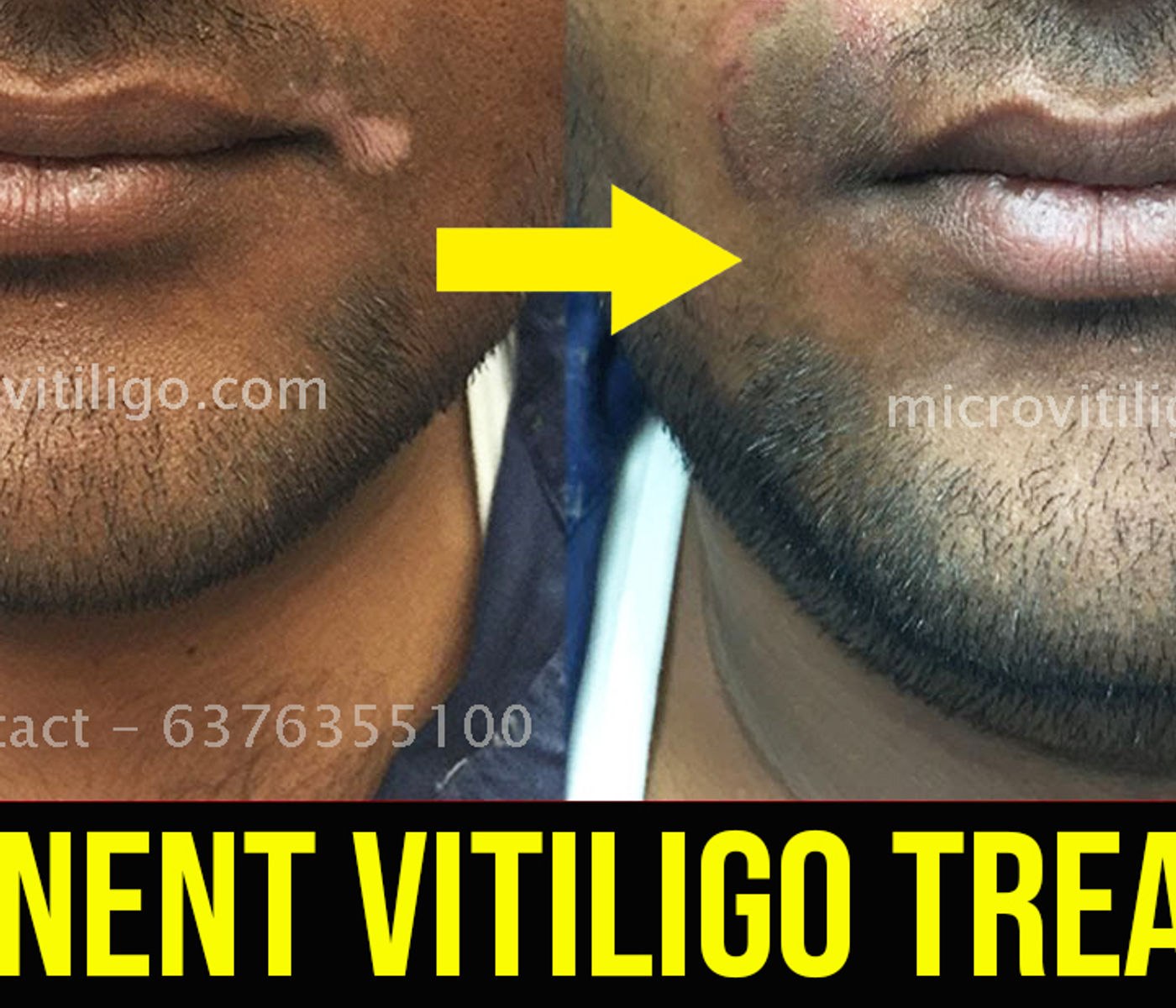 Cosmetic skin camouflage result
