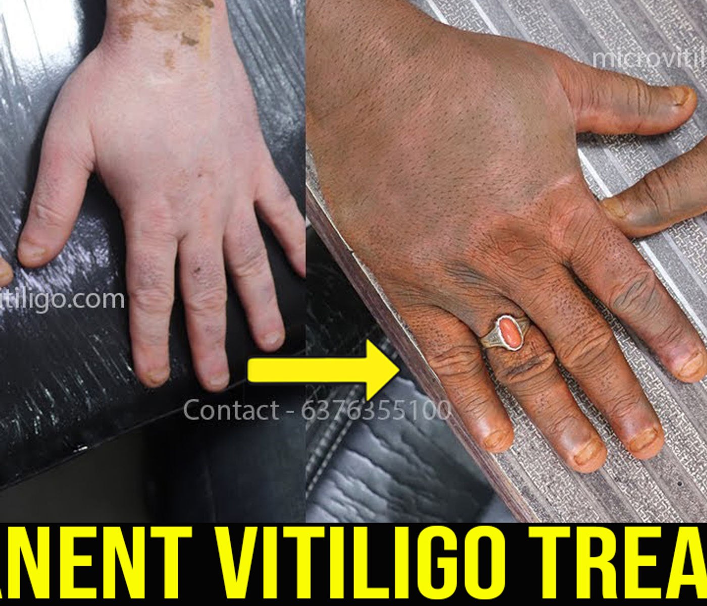 Cosmetic skin camouflage result
