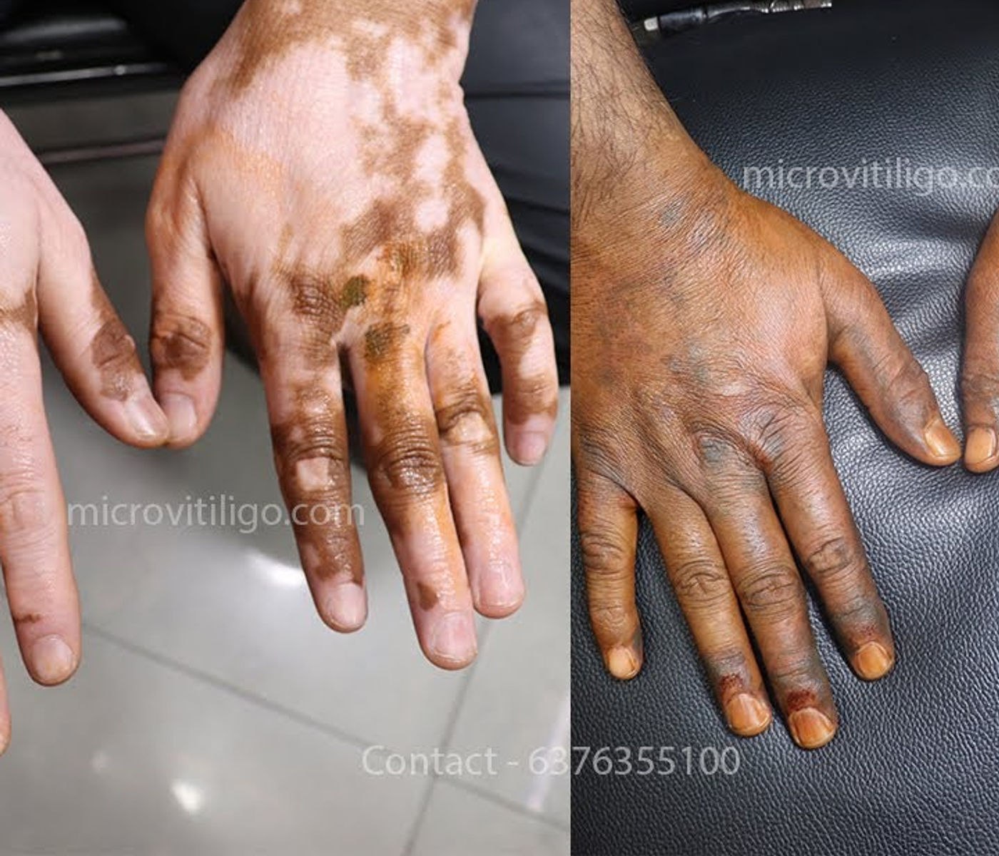 Cosmetic skin camouflage result