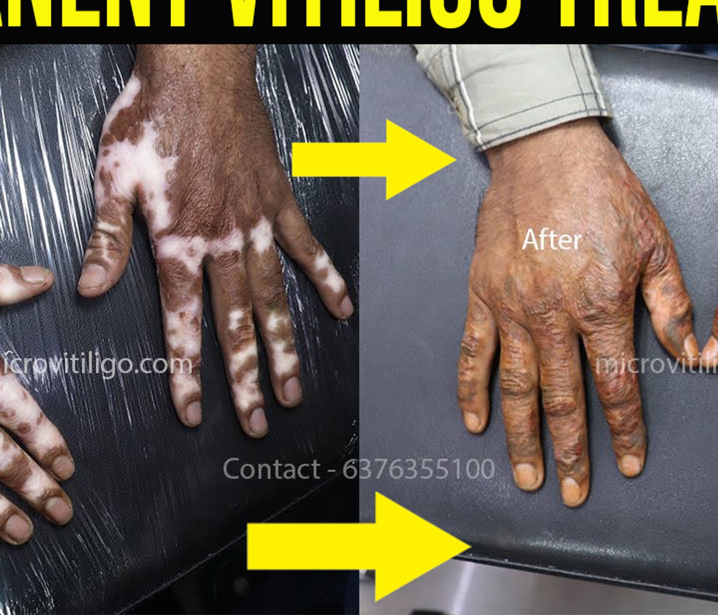 Cosmetic skin camouflage result