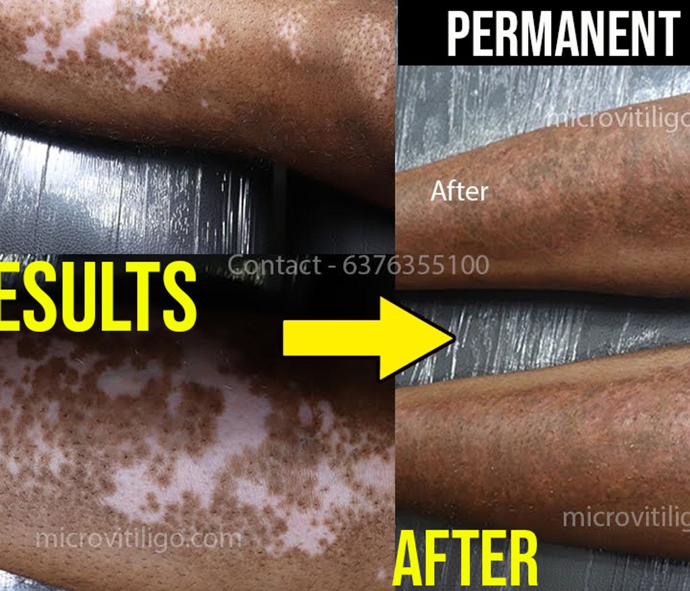 Cosmetic skin camouflage result