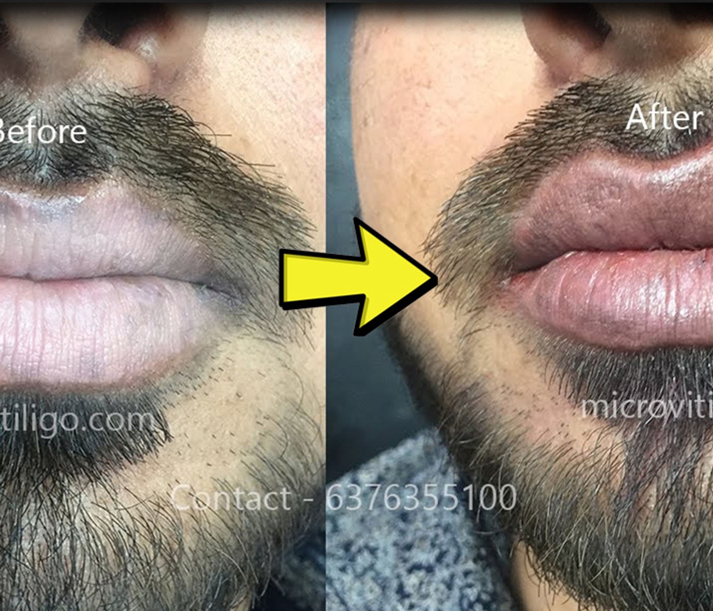 Cosmetic skin camouflage result