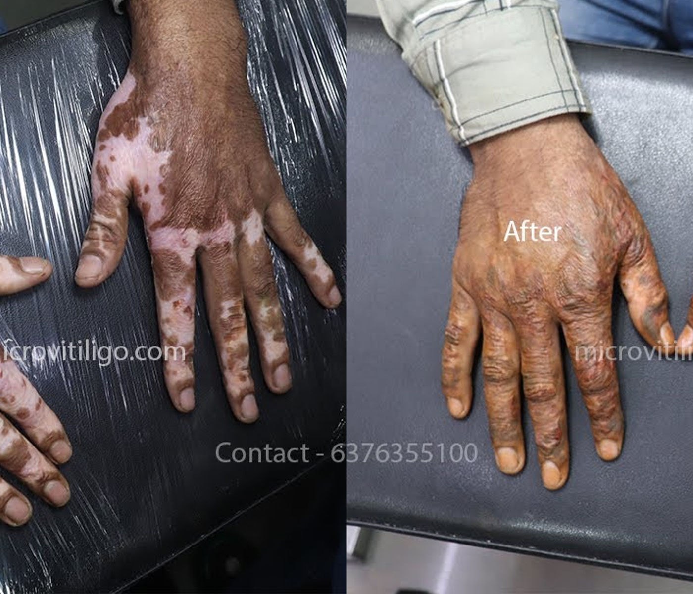 Cosmetic skin camouflage result