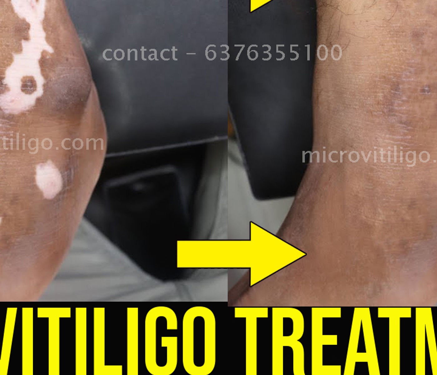 Cosmetic skin camouflage result