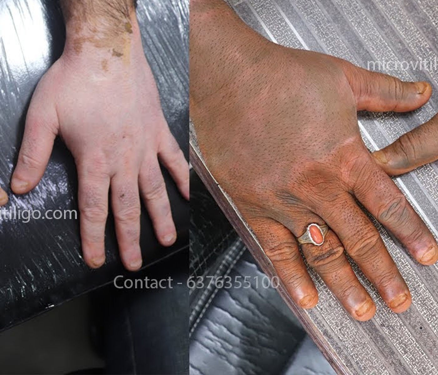 Cosmetic skin camouflage result