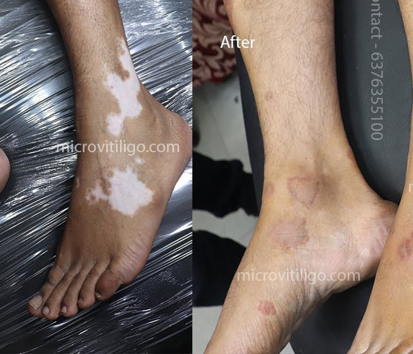 Cosmetic skin camouflage result