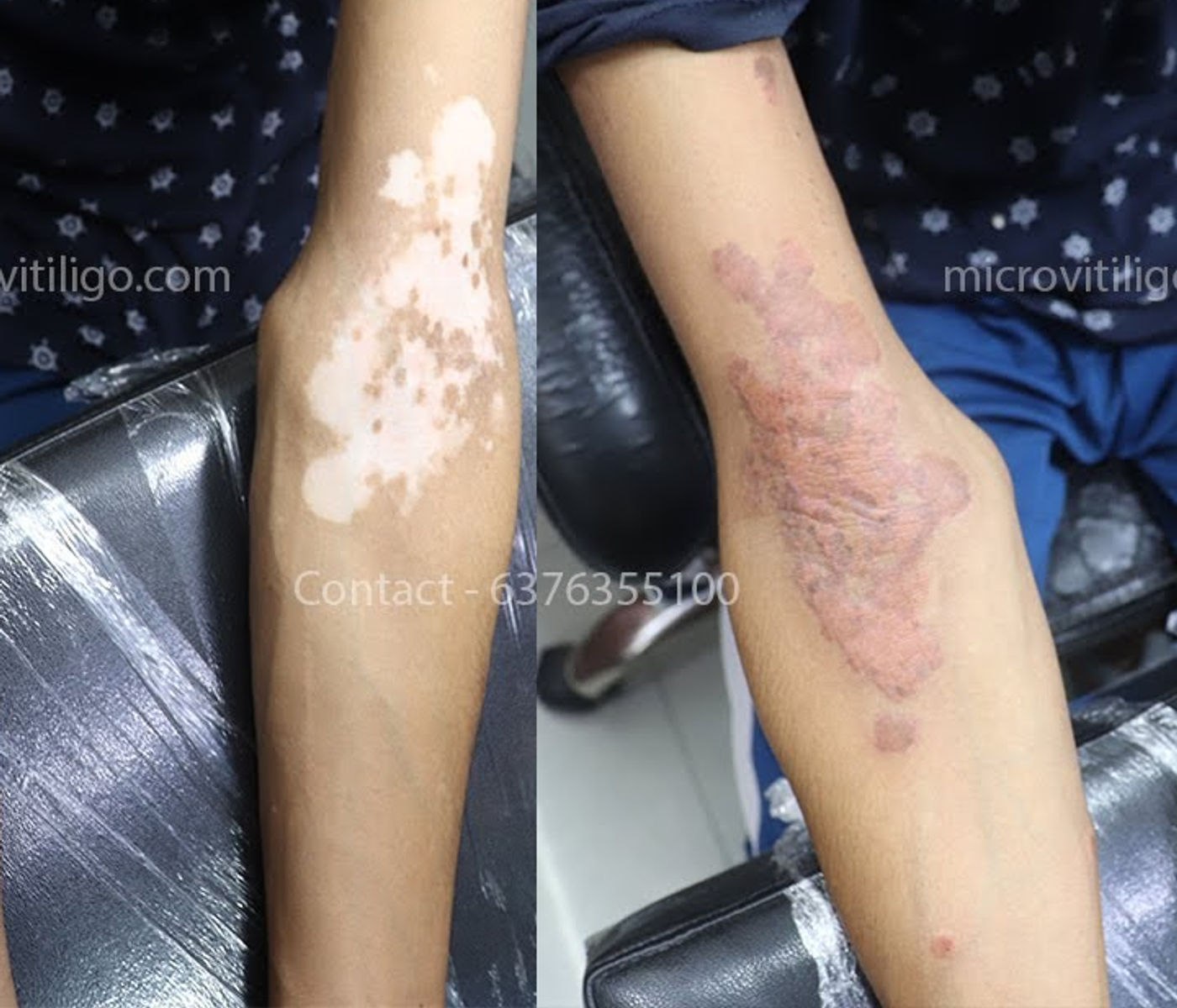 Cosmetic skin camouflage result